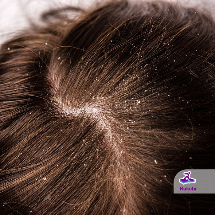 چگونه پوسته سر را درمان کنیم؟ راهکارهای علمی برای داشتن پوستی سالم