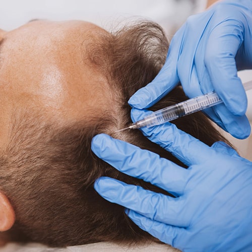 مزوتراپی-بهتر-است-یا-هیرفیلر؟-انتخاب-بر-اساس-نوع-ریزش-مو-min