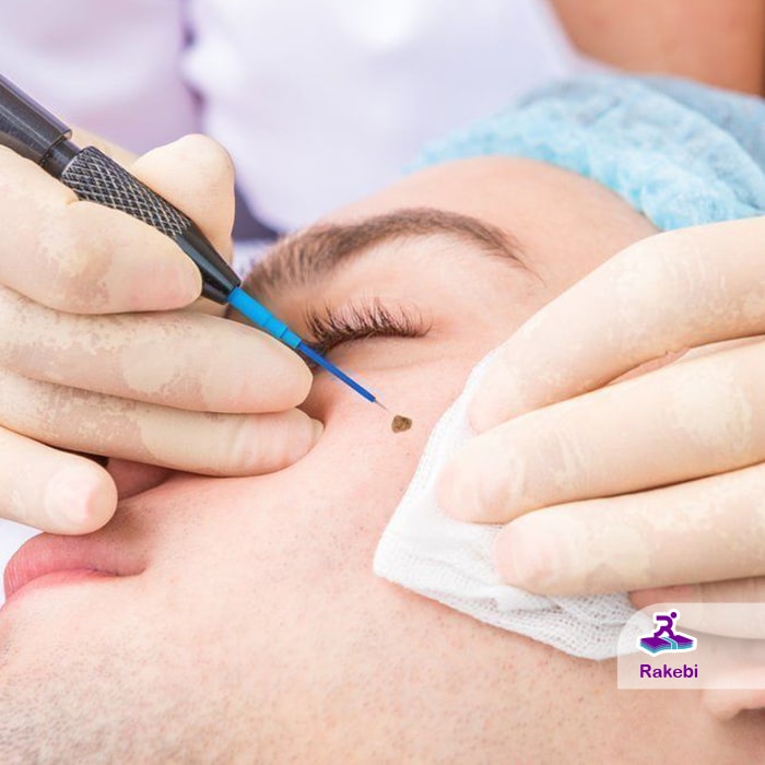 خال برداری چگونه انجام می‌شود