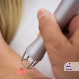 پس از برداشتن خال با لیزر جای زخم باقی می‌گذارد؟