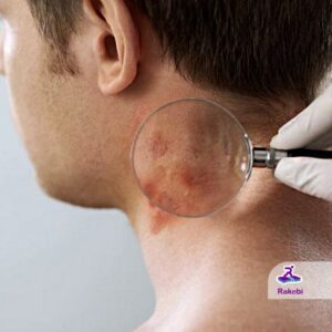 چرا سوختگی ناشی از لیزر اتفاق می‌افتد و چطور آن را درمان کنیم؟