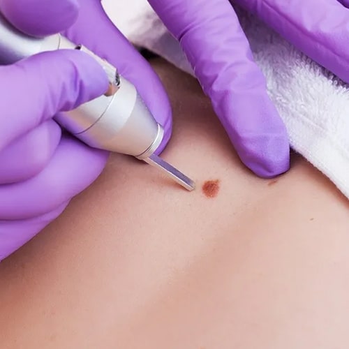 مراقبت‌های-بعد-از-خال-برداری-برای-بهبود-سریع‌تر-و-جلوگیری-از-عوارض-min