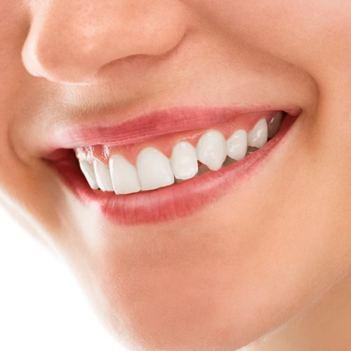 مقایسه-کامپوزیت-و-لمینت-کدام-گزینه-برای-دندان‌های-شما-بهتر-است؟-min