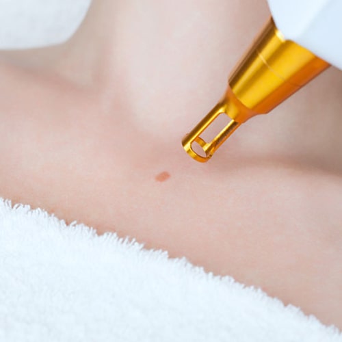 هزینه-برداشتن-خال-با-لیزر-در-سال-1404-چقدر-است؟-min