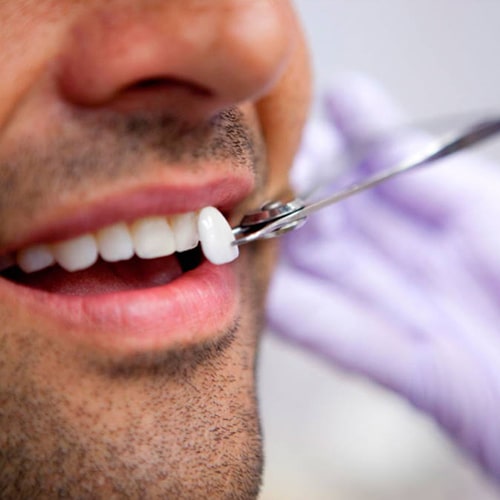 کامپوزیت و لمینت دندان چه تفاوتی با هم دارند؟-min