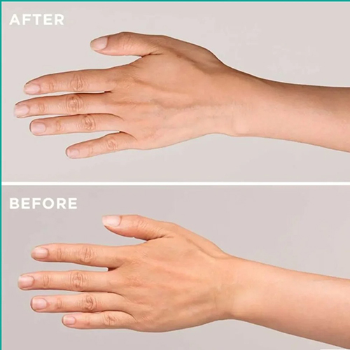 مراحل انجام جوانسازی دست با دستگاه آر اف از مشاوره تا نتیجه نهایی