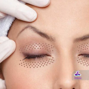 چگونه با پلاسماجت پلک افتادگی چشم را بدون نیاز به جراحی درمان کنیم؟