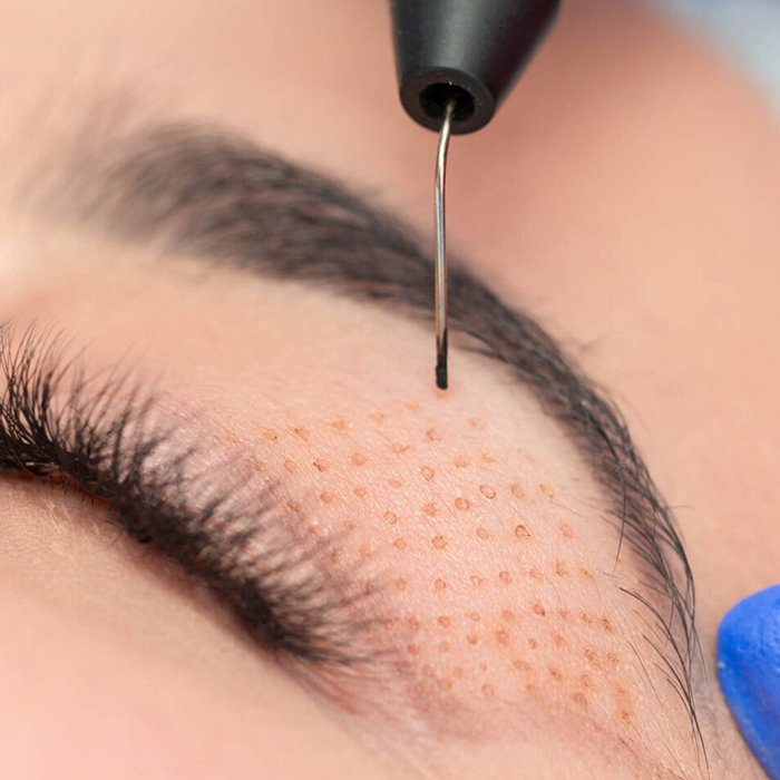 پلاسماجت پلک چیست و چگونه باعث لیفت پوست می‌شود؟