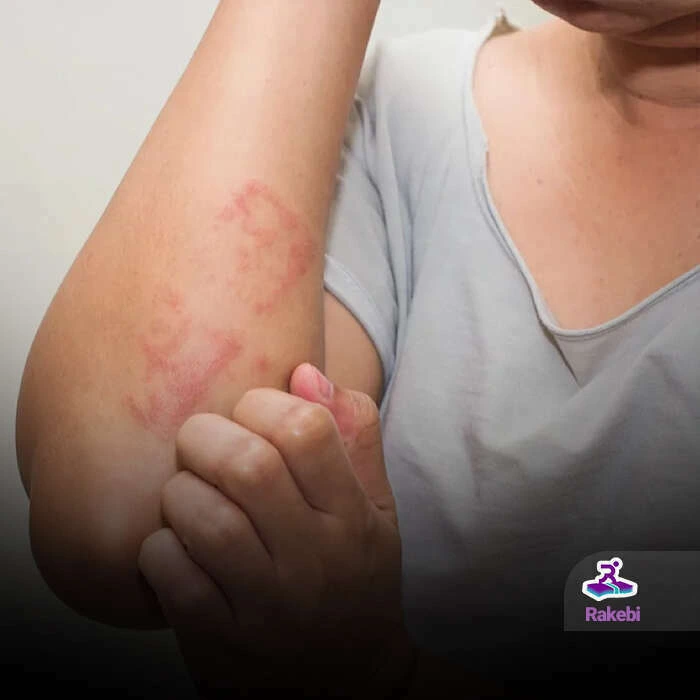 درمان گال پوستی