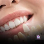 سفیدترین رنگ کامپوزیت