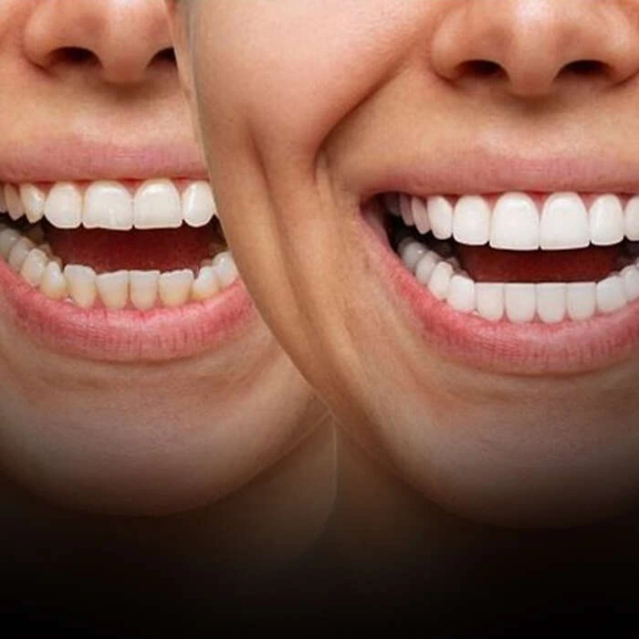 سفیدترین رنگ کامپوزیت IPS