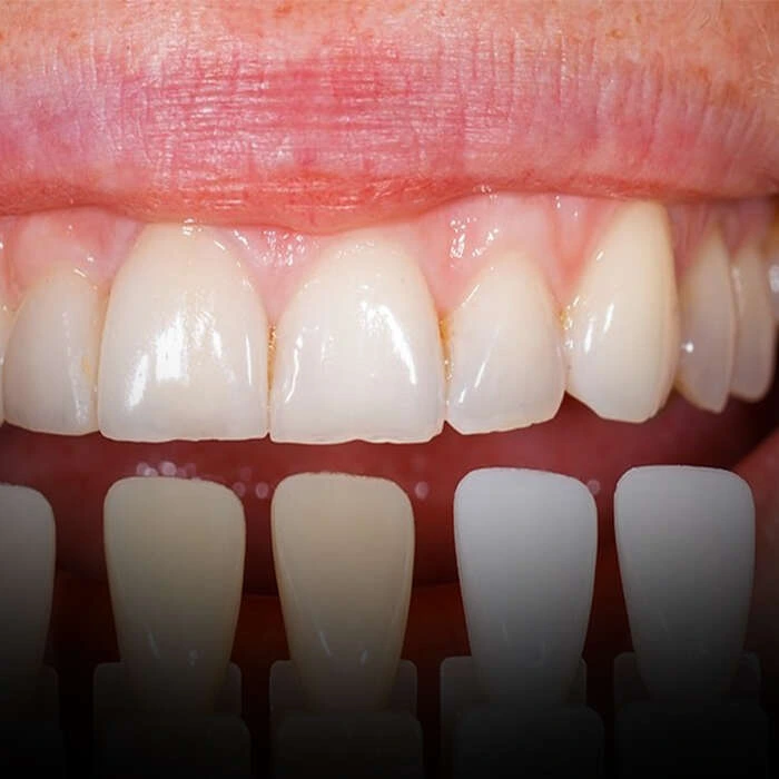 سفیدترین رنگ کامپوزیت توکویاما